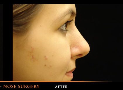 Rhinoplasty Before & After Patient #1195