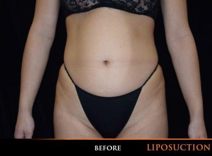 Liposuction Before & After Patient #1093
