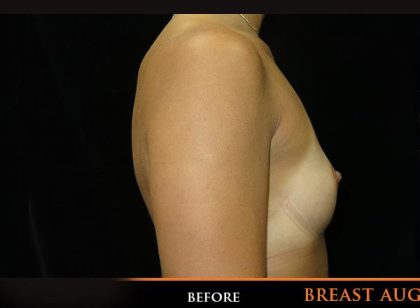 Breast Augmentation Before & After Patient #518