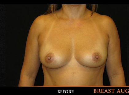 Breast Augmentation Before & After Patient #532