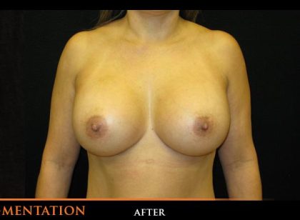 Breast Augmentation Before & After Patient #532