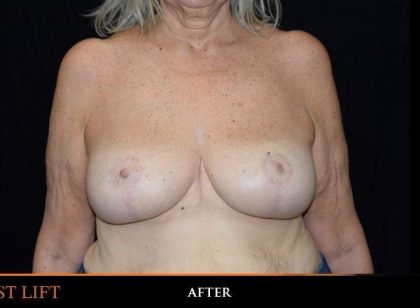Breast Lift Before & After Patient #758