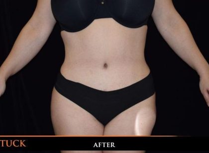 Tummy Tuck Before & After Patient #1924