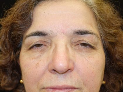 Blepharoplasty Before & After Patient #3177