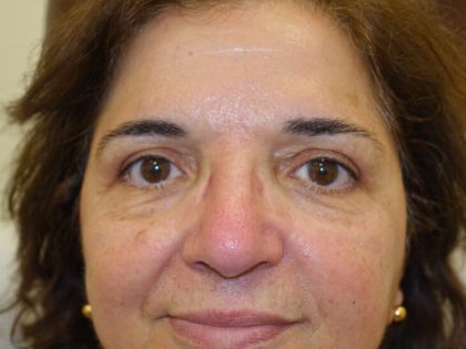 Blepharoplasty Before & After Patient #3177