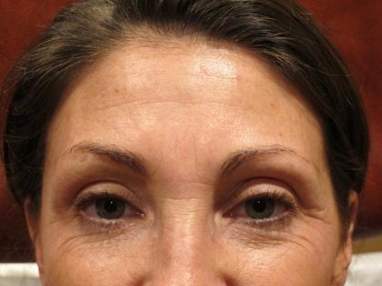 Botox Before & After Patient #1268