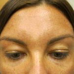 Injectable Glabella Before & After Patient #1250