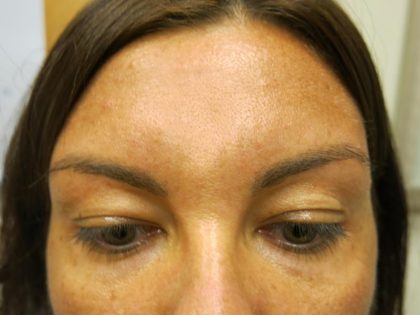Injectable Glabella Before & After Patient #1250
