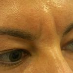 Injectable Glabella Before & After Patient #1250