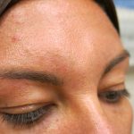 Injectable Glabella Before & After Patient #1250