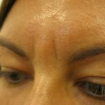 Injectable Glabella Before & After Patient #1250