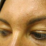Injectable Glabella Before & After Patient #1250