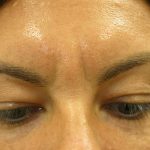 Injectable Glabella Before & After Patient #1250