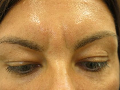 Injectable Glabella Before & After Patient #1250