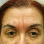 Injectable Glabella Before & After Patient #3262