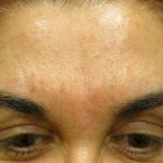 Injectable Glabella Before & After Patient #3262