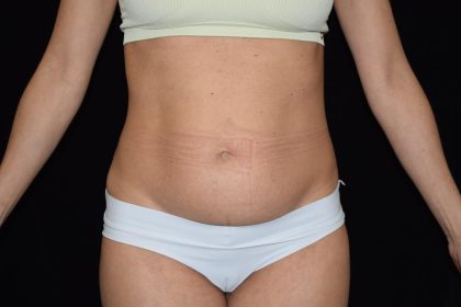 Tummy Tuck Before & After Patient #1929