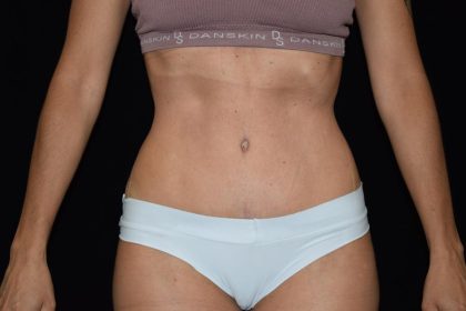 Tummy Tuck Before & After Patient #1929
