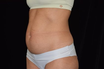 Tummy Tuck Before & After Patient #1929