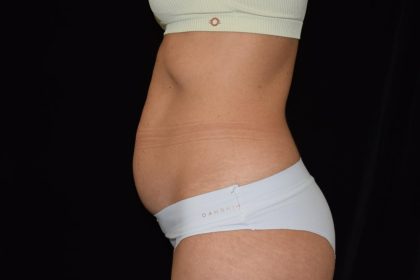 Tummy Tuck Before & After Patient #1929