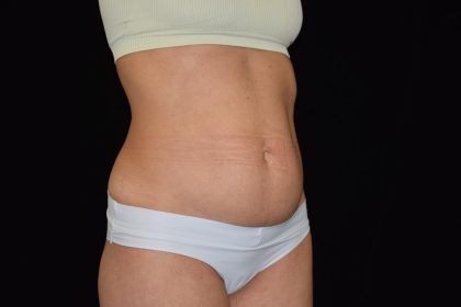 Tummy Tuck Before & After Patient #1929