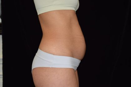 Tummy Tuck Before & After Patient #1929