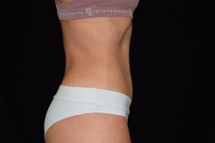 Tummy Tuck Before & After Patient #1929